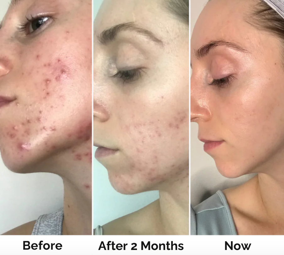 SkinDerma High Frequeny Wand Anti-Aging & Anti-Acne