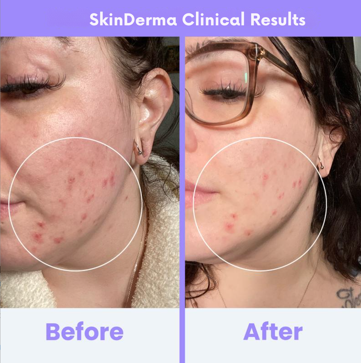 SkinDerma High Frequeny Wand Anti-Aging & Anti-Acne