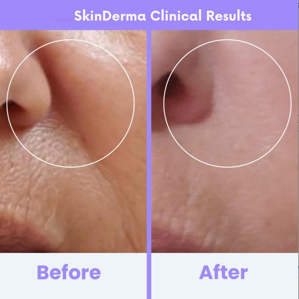 SkinDerma High Frequeny Wand Anti-Aging & Anti-Acne