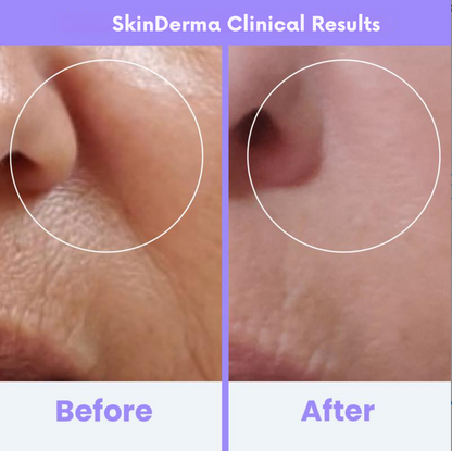 SkinDerma High Frequeny Wand Anti-Aging & Anti-Acne